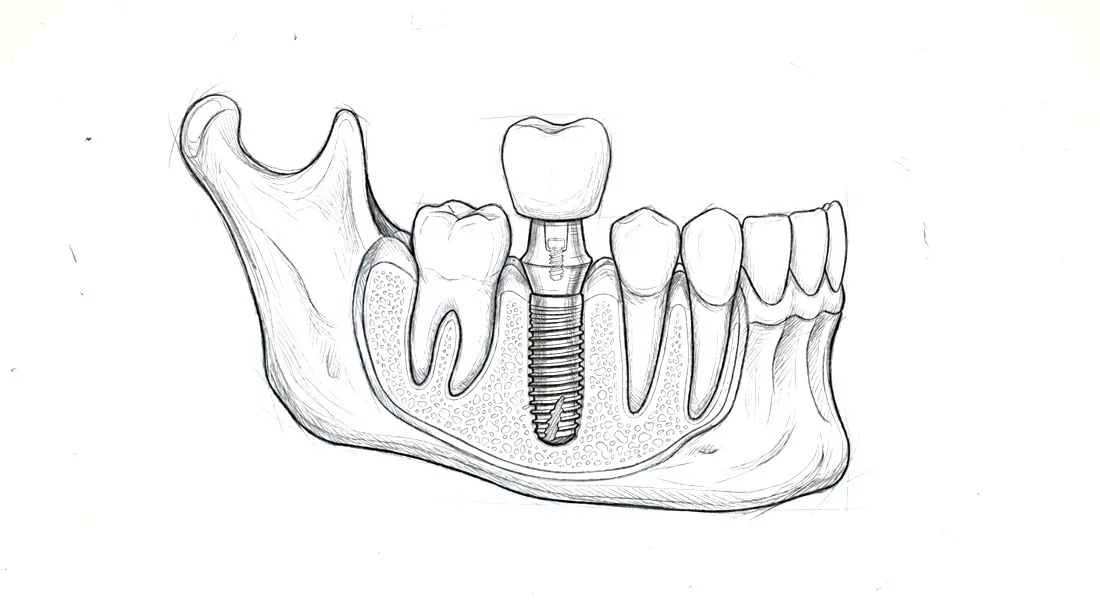 Anatomische Darstellung eines Zahnimplantats im Kieferknochen